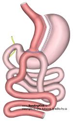 žaludeční bypass s tzv. omega kličkou