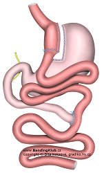Žaludeční bypass Roux en Y