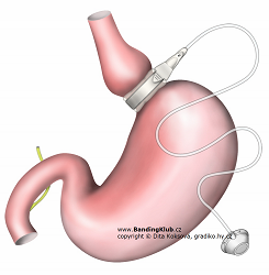 bandáž žaludku