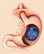 Bioenterics Intragastric Balloon