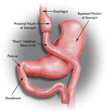 Gastricky (zaludecni) bypass