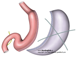 Tubulizace žaludku